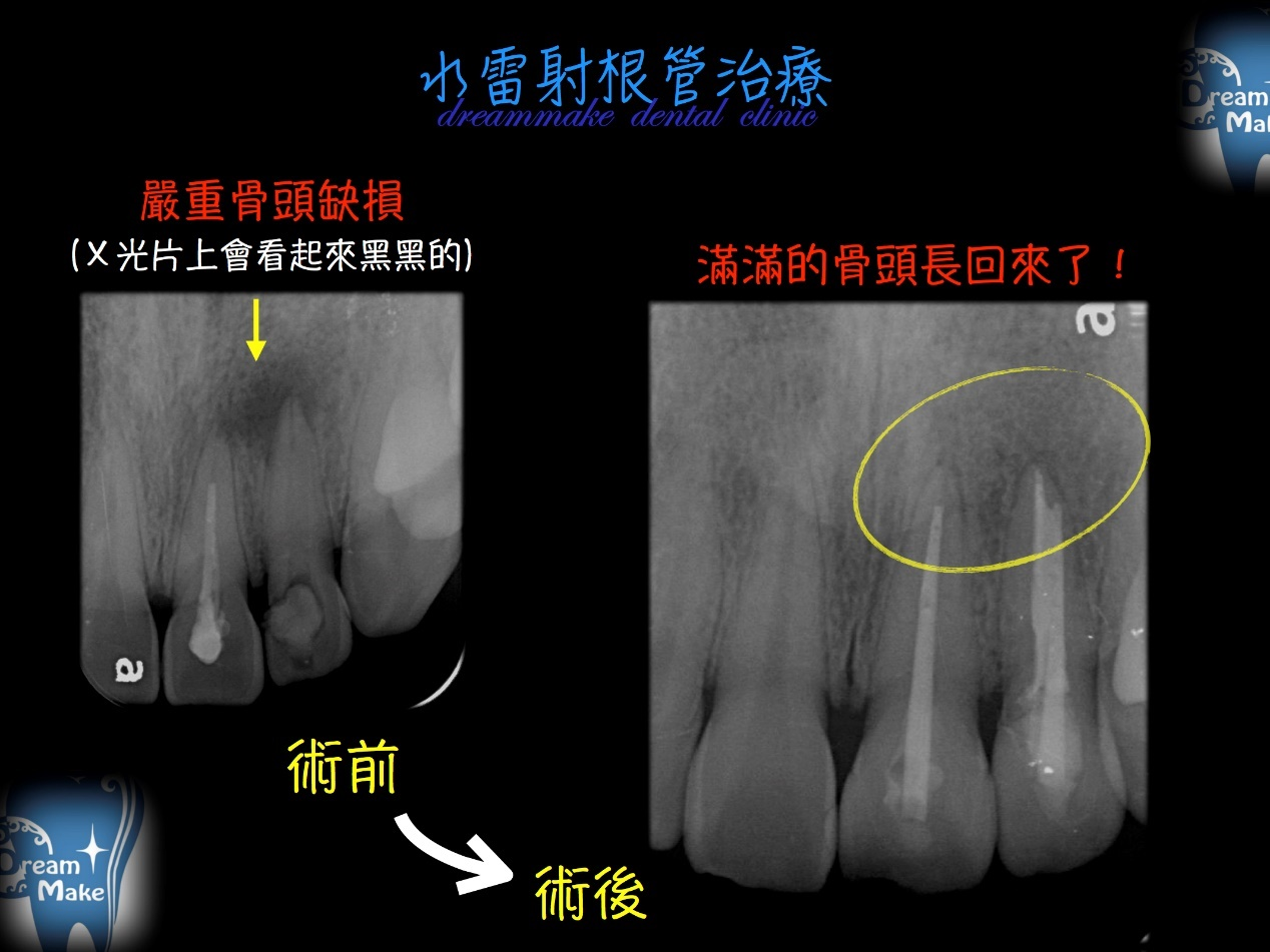 根管治療